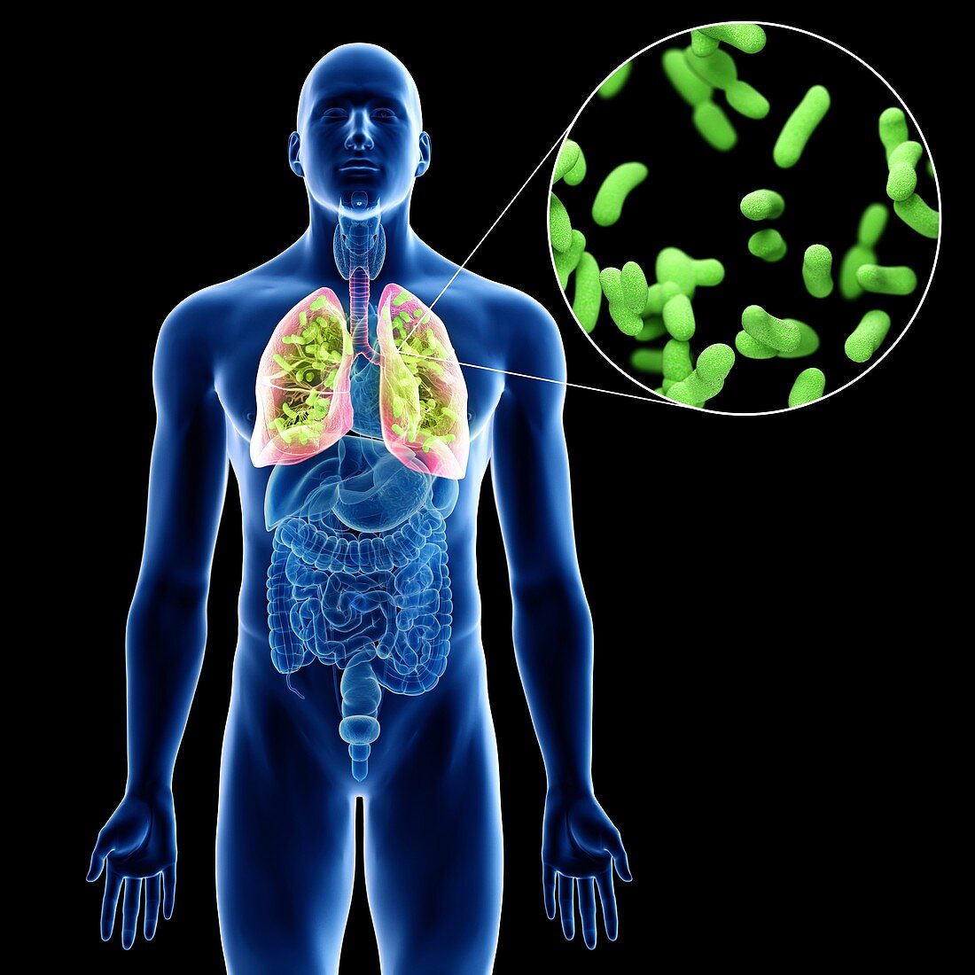 Illustration of a man's lung infection