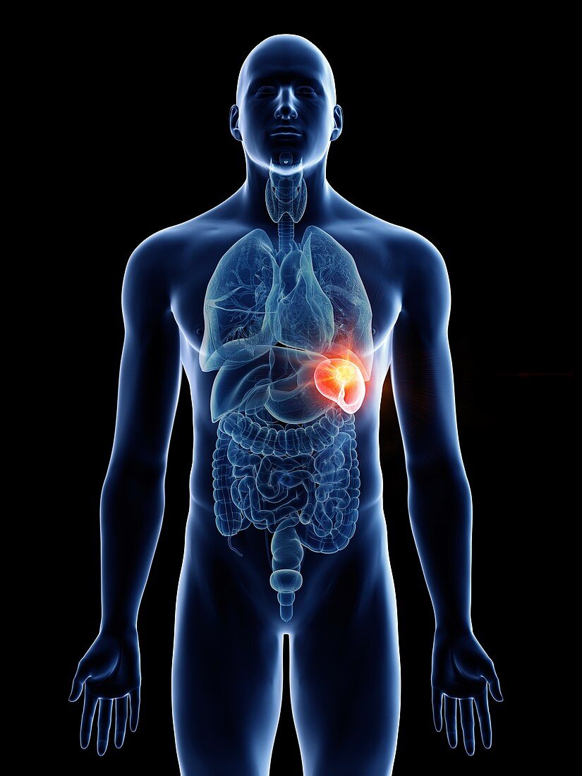 Illustration of a man's spleen cancer