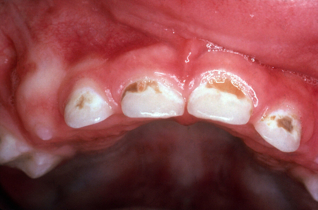 Baby Bottle Tooth Decay