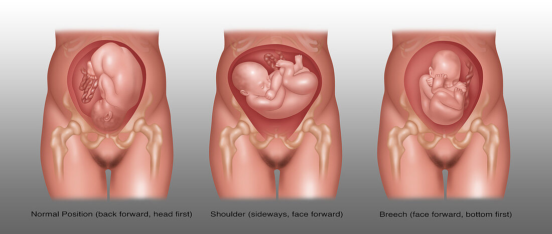 Foetus Positions in Uterus, Illustration