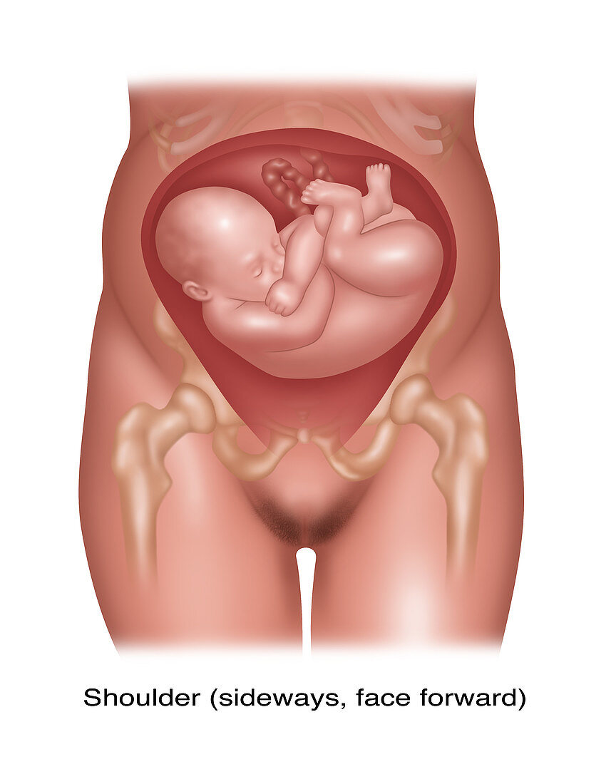 Foetus in Shoulder Position, Illustration