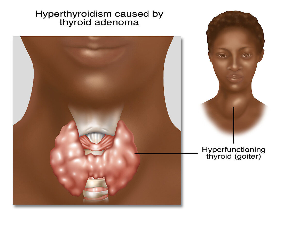 Hyperthyroidism, Illustration