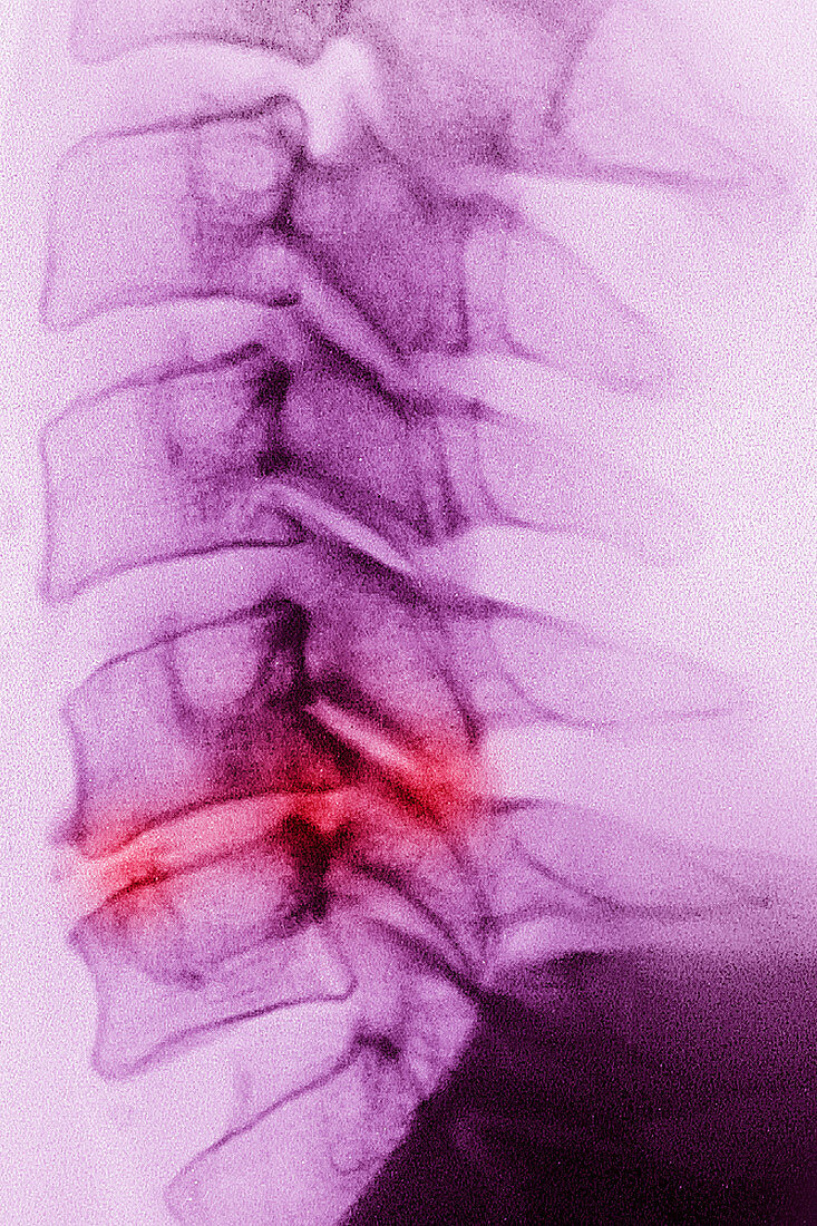 Osteoarthritis in Vertebrae C5-C6, X-ray