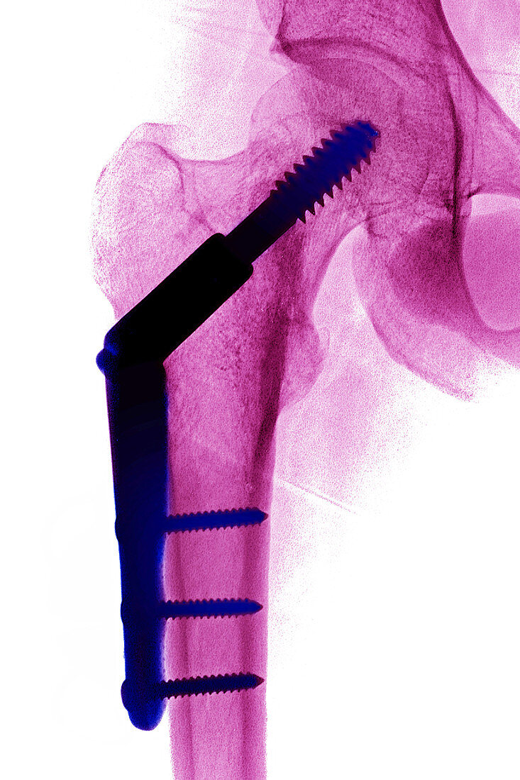 Hip with Nail-plate, Osteosynthesis, X-ray