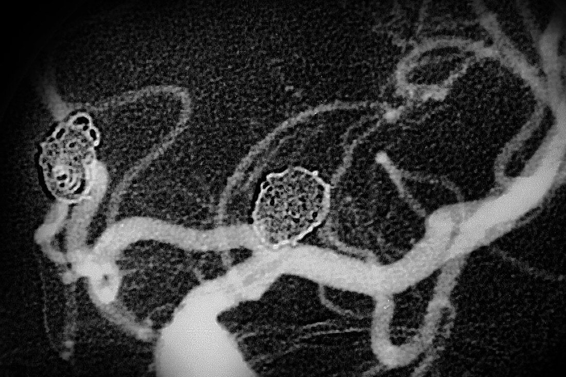 Coil Embolization of Aneurysms, Angiography