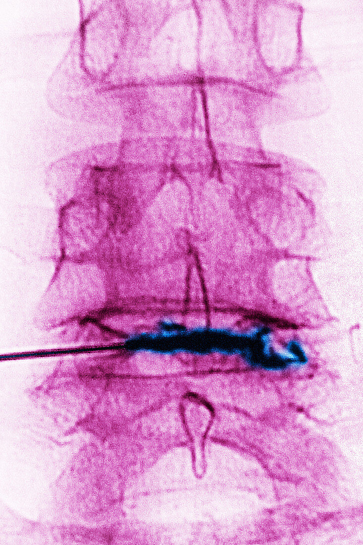 Steroid Injection into Spine, X-ray