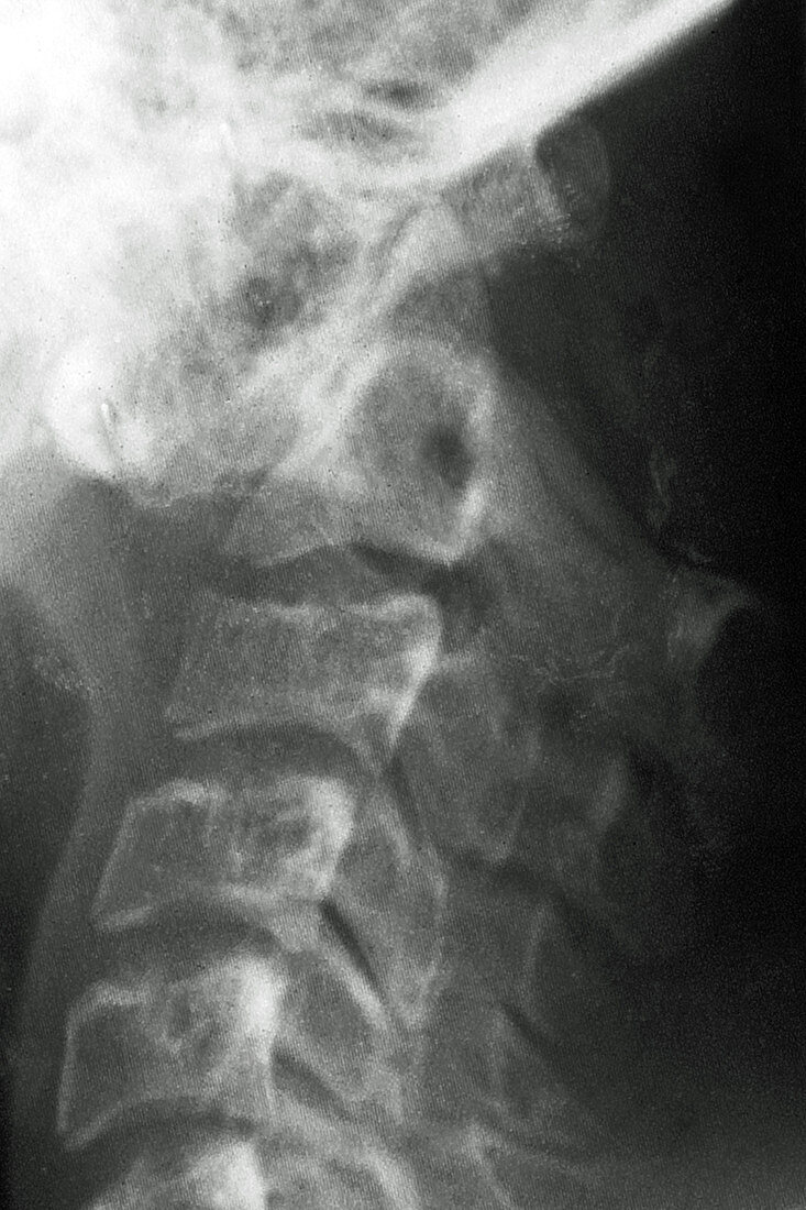 Dislocation of C1 & C2 Vertebrae