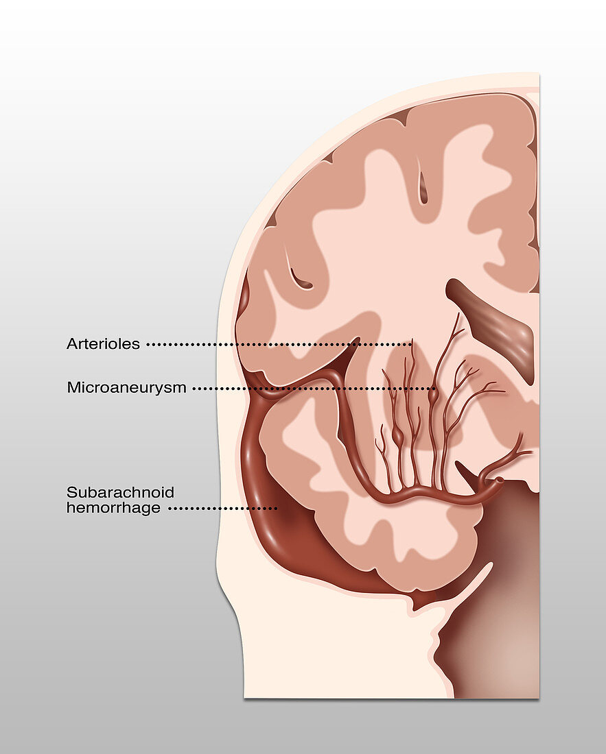 Haemorrhagic Stroke Locations, Illustration