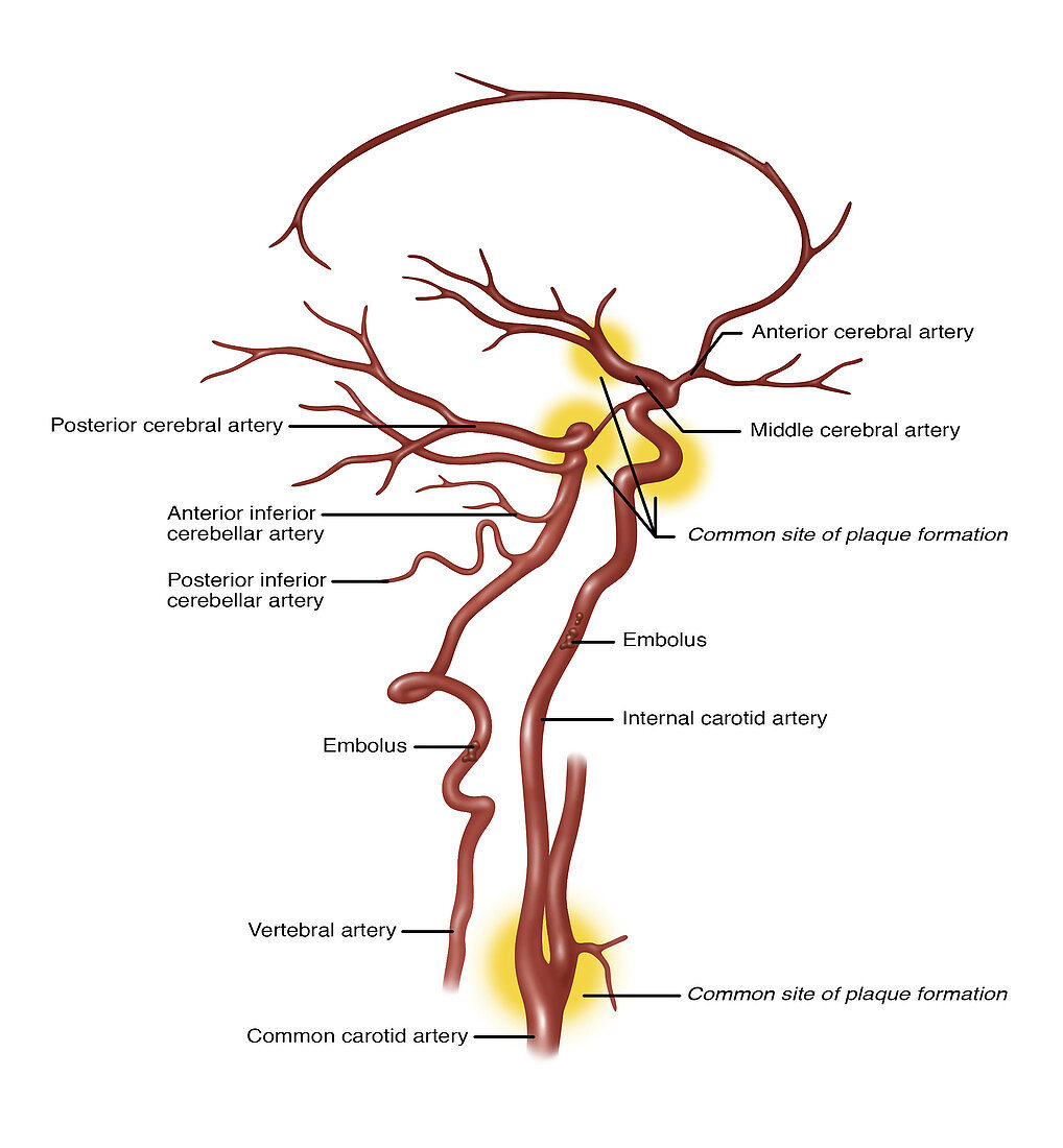 Common Blocked Arteries, Illustration