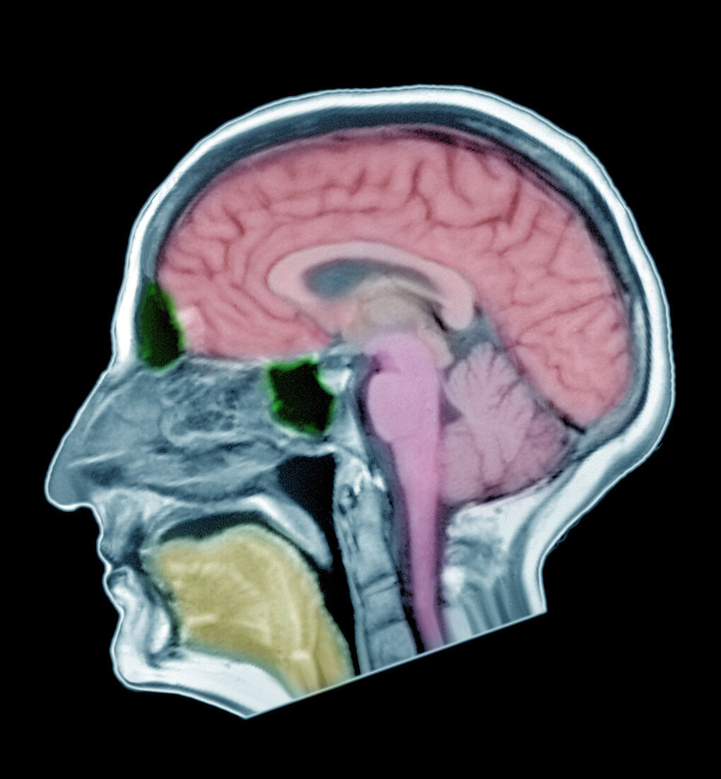 Normal Adult Male Brain, MRI
