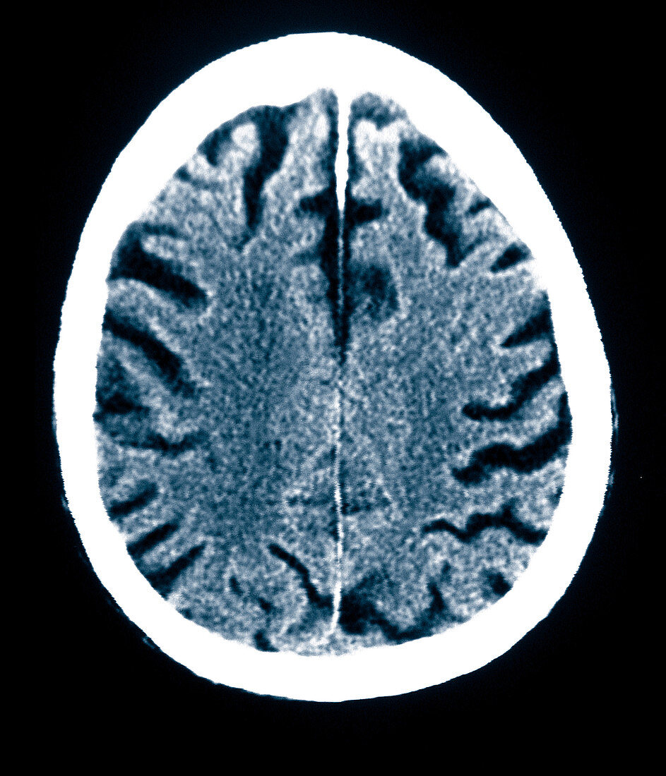 Brain of Alzheimer's Patient, CT Scan