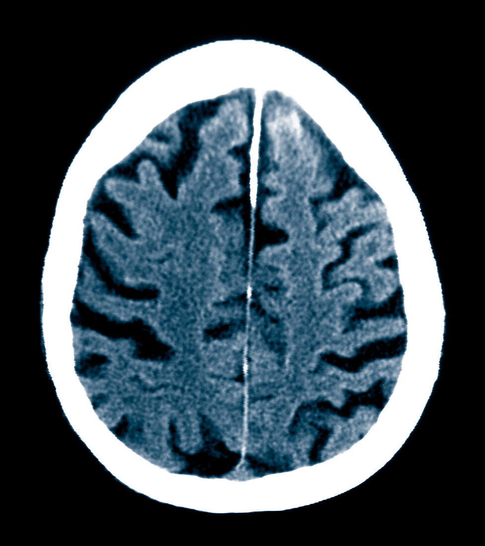 Brain of Alzheimer's Patient, CT Scan