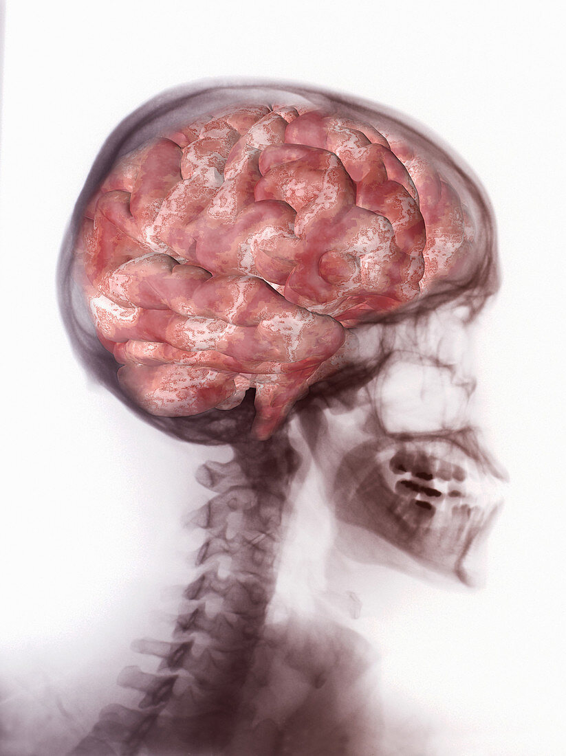 Brain Inside Skull, Artwork on X-ray