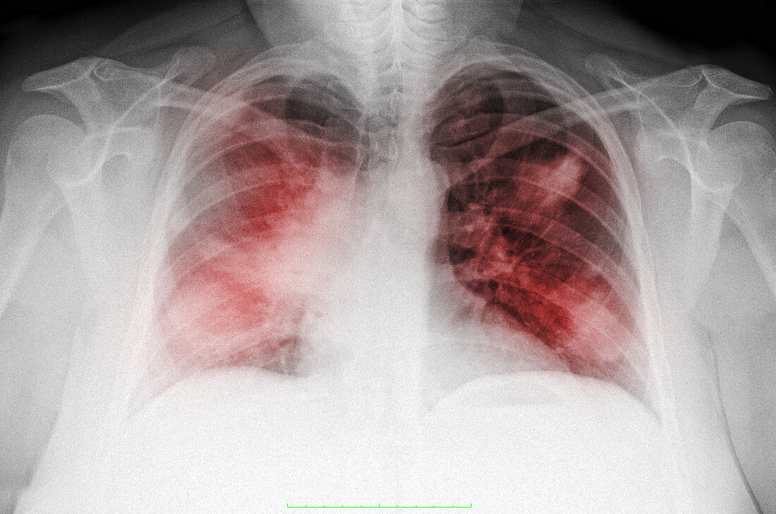 Atypical Pneumonia in Smoker, X-ray