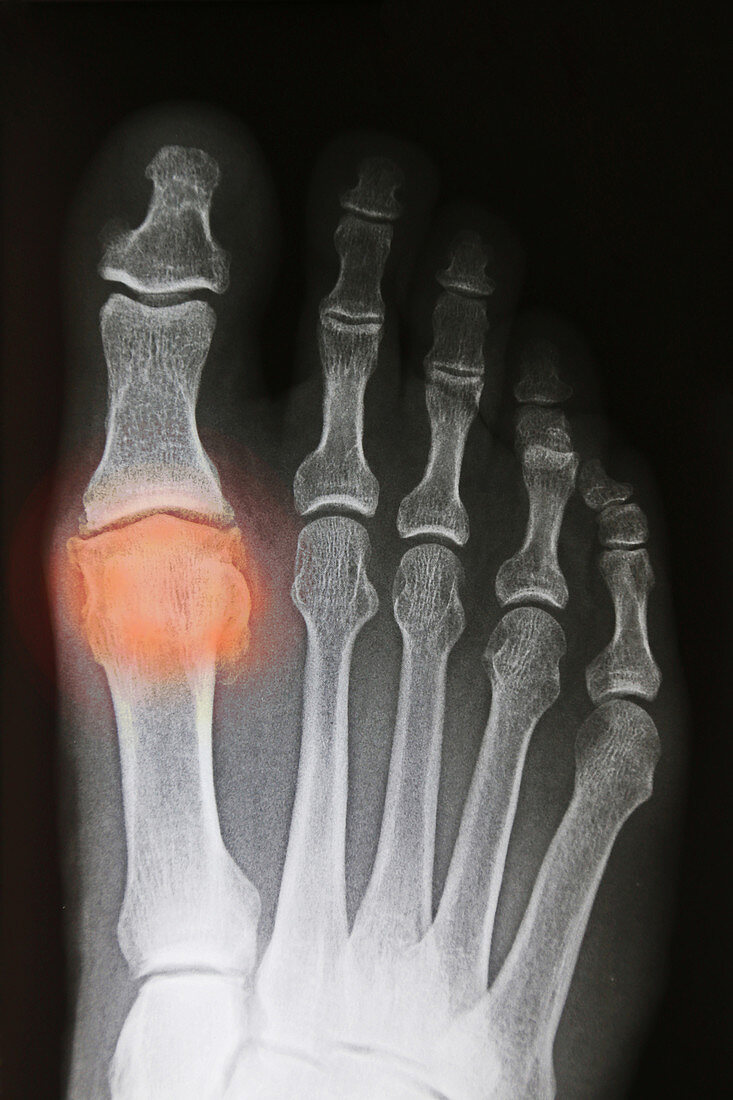 Osteoarthritis of Big Toe, X-Ray