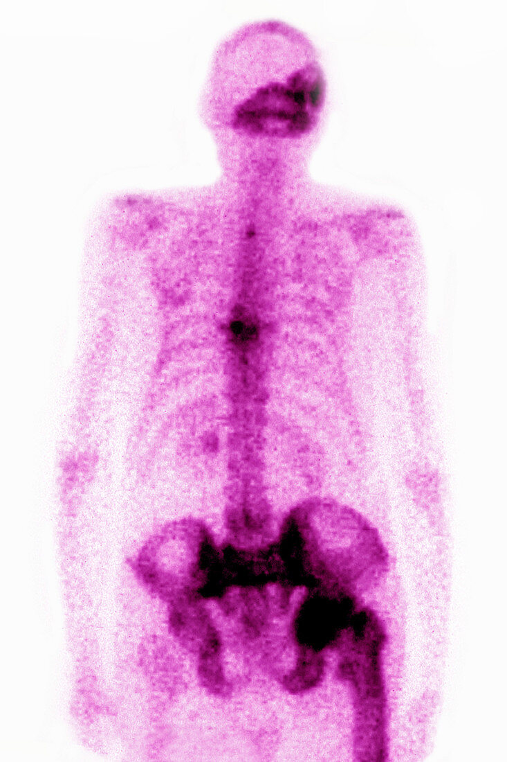 Paget's Disease, Scintigraphy