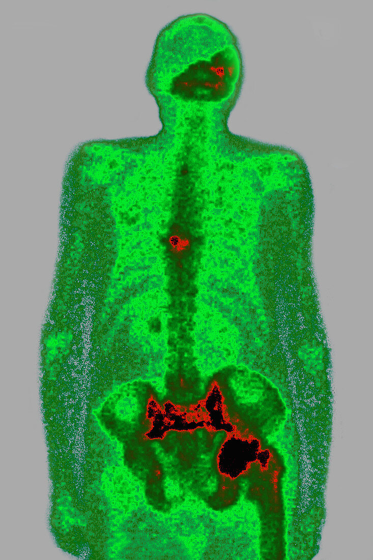 Paget's Disease, Scintigraphy