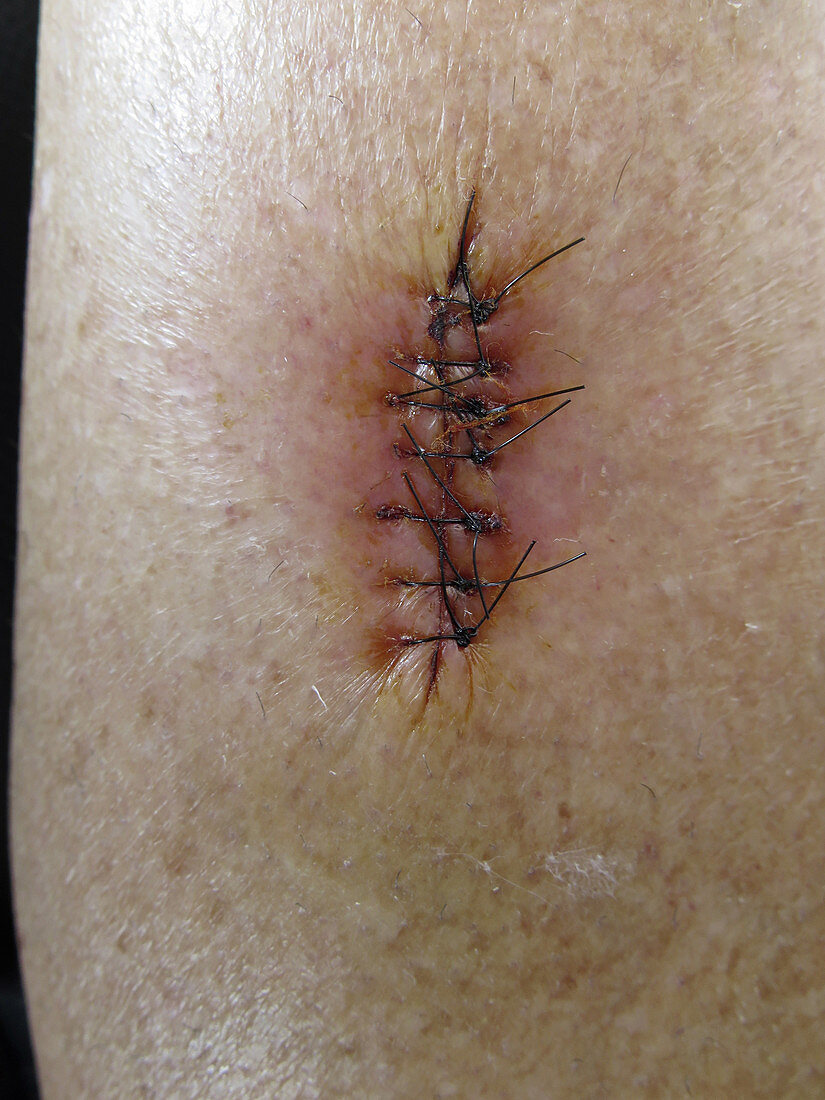 Stitches After Skin Cancer Removal