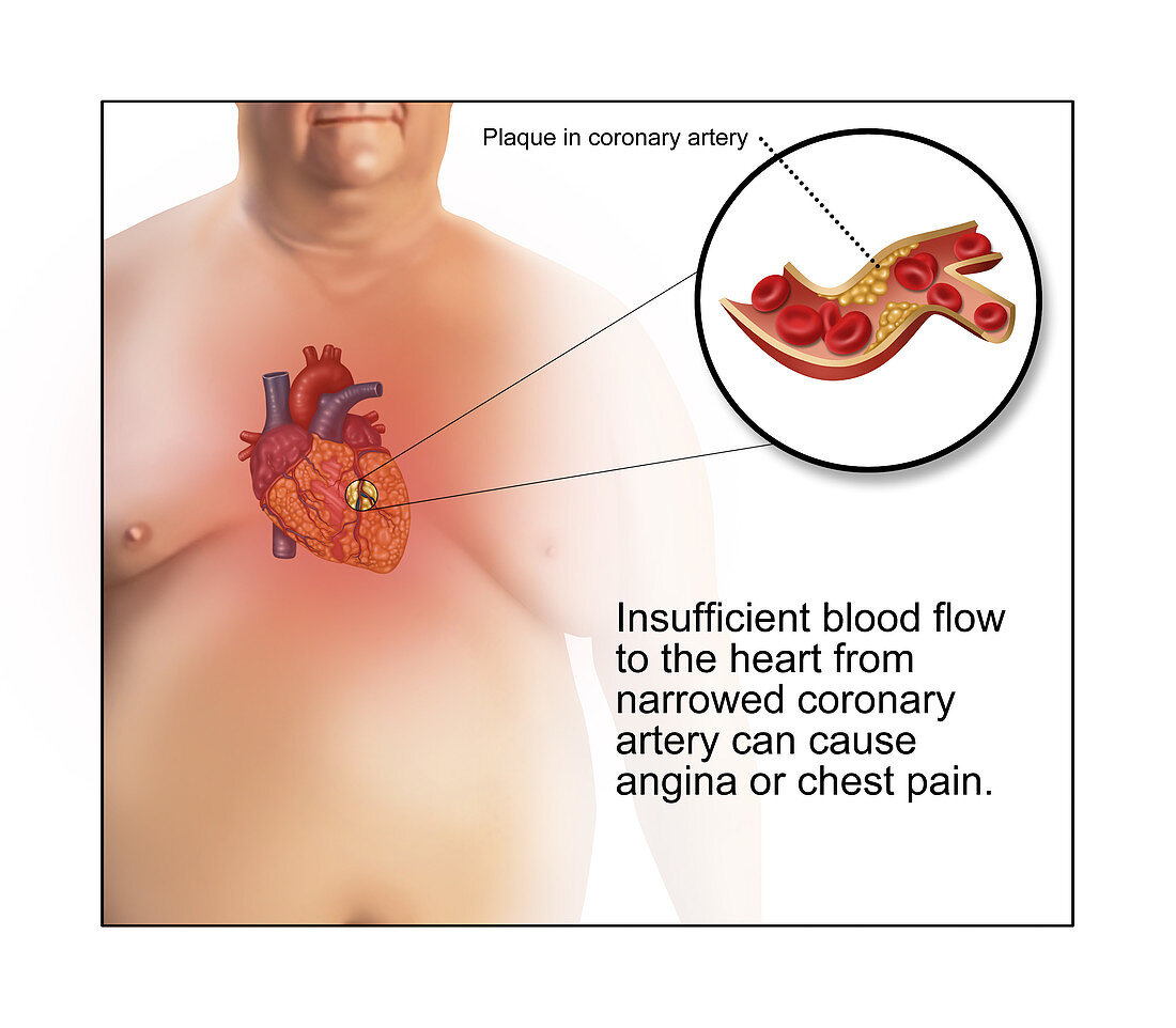 Coronary Artery Plaque Causing Angina