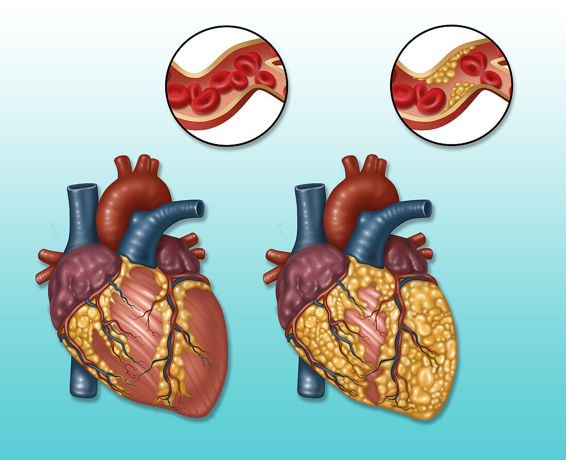 Heart and Artery, Normal vs. Hardened