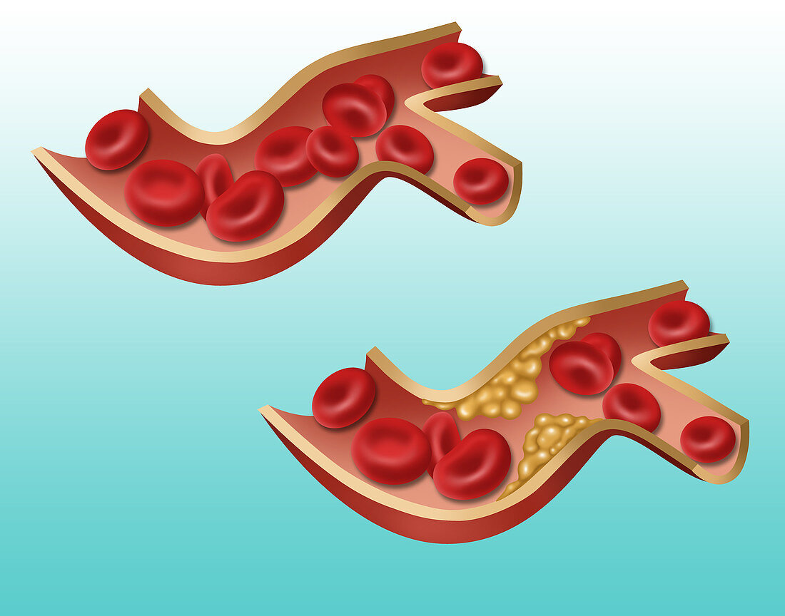 Artery, Normal vs. Hardened, Illustration