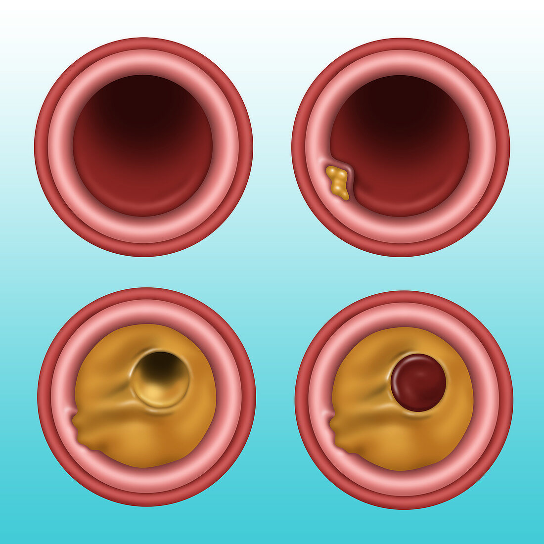 Clogged Artery, Illustration