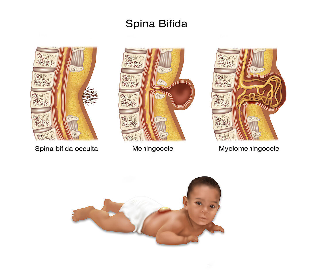 Spina Bifida, Illustration
