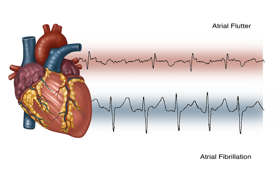 Illustration of Irregular Heartbeats