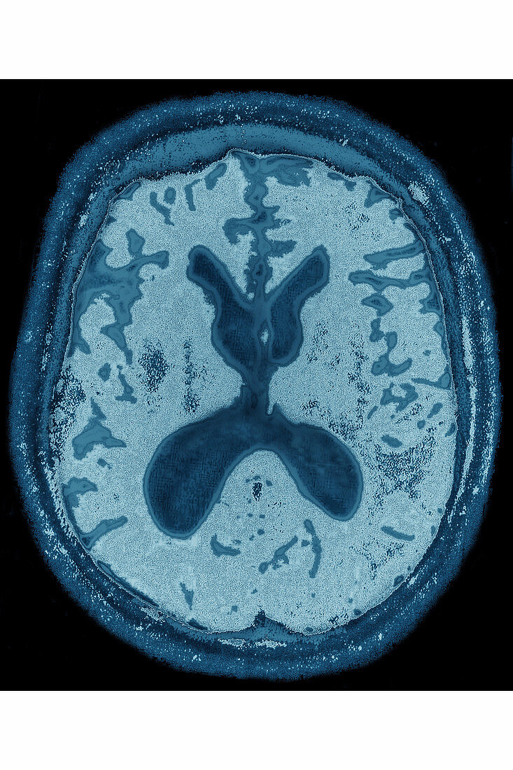 Alzheimer's disease, MRI