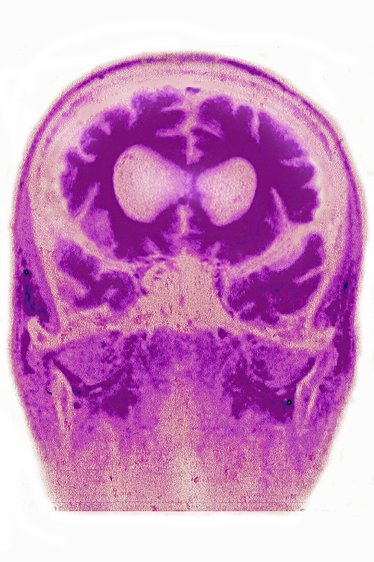 Alzheimer's disease, MRI