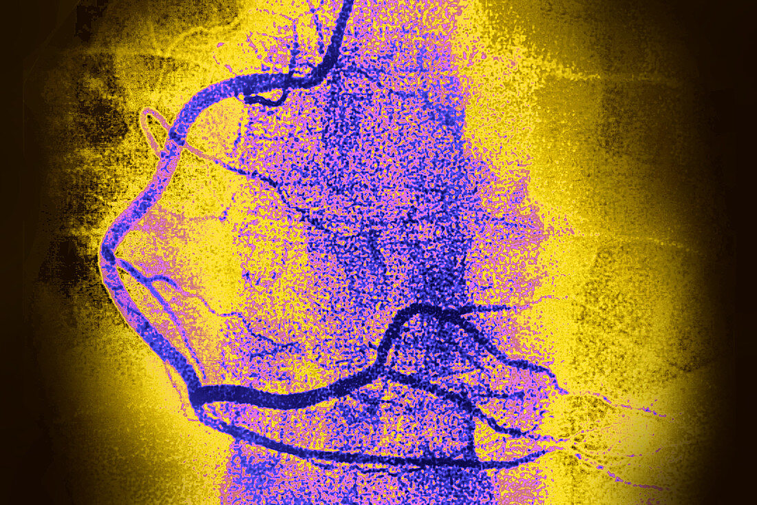 Coronary artery, Angiograph