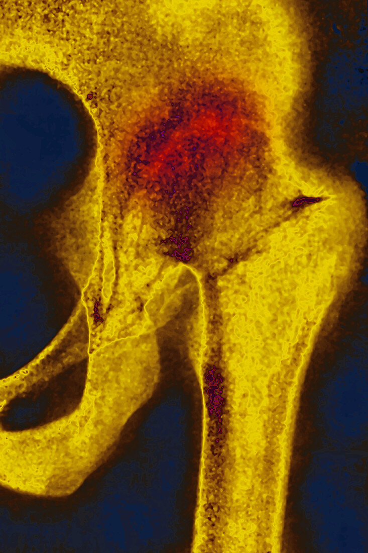 Osteoarthritis, X-ray