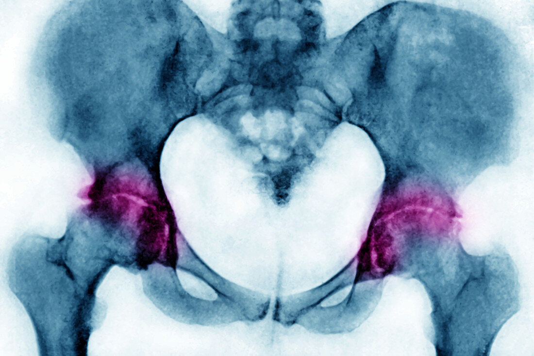 Arthritis of the hips, X-ray