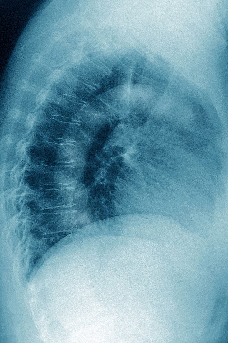 Calcific aortic arch atheroma, X-ray