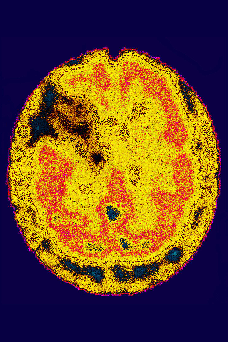 Stroke, brain scintigraphy