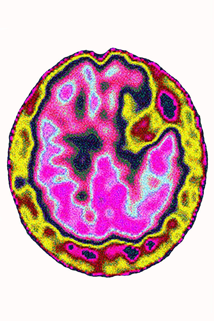 Stroke, brain scintigraphy