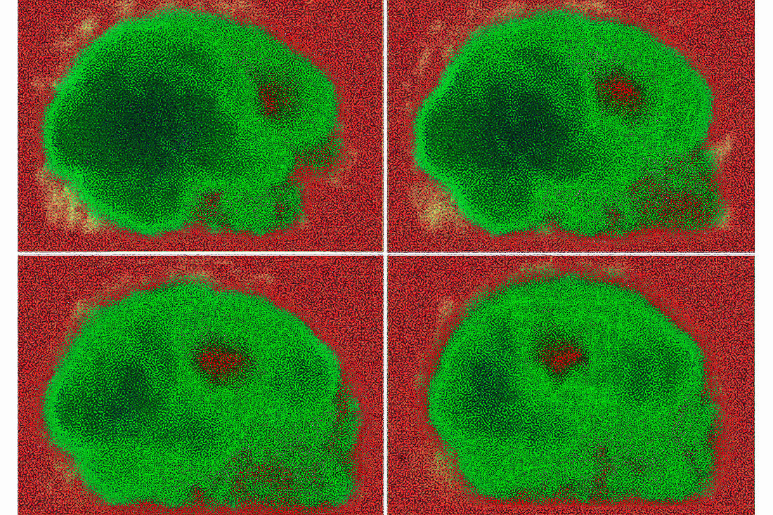 Stroke, brain scintigraphy