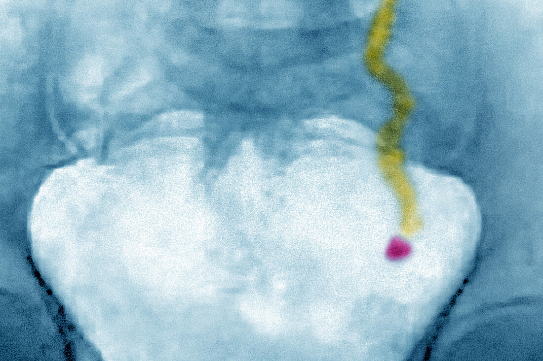 Renal colic, X-ray