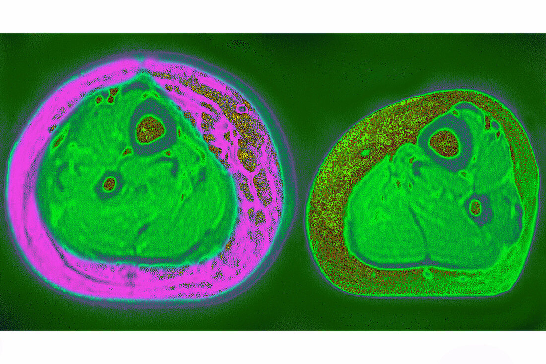 Edema, CT scan