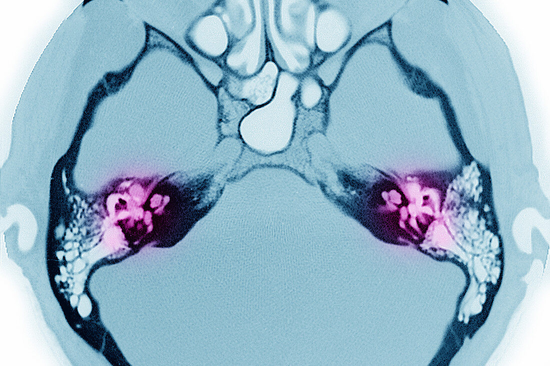 Inner ears, CT scan