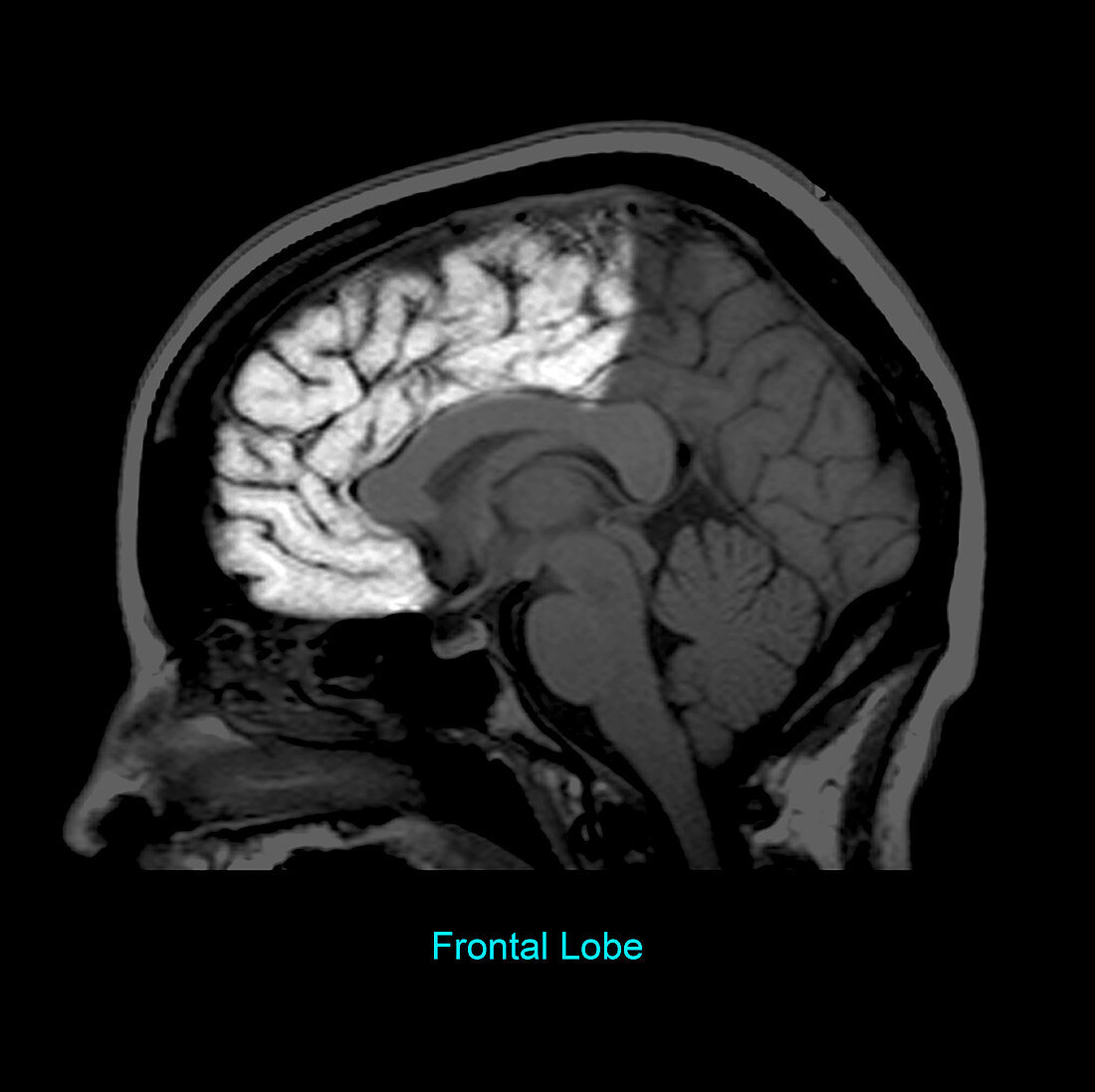 Frontal Lobe, Sagittal MRI