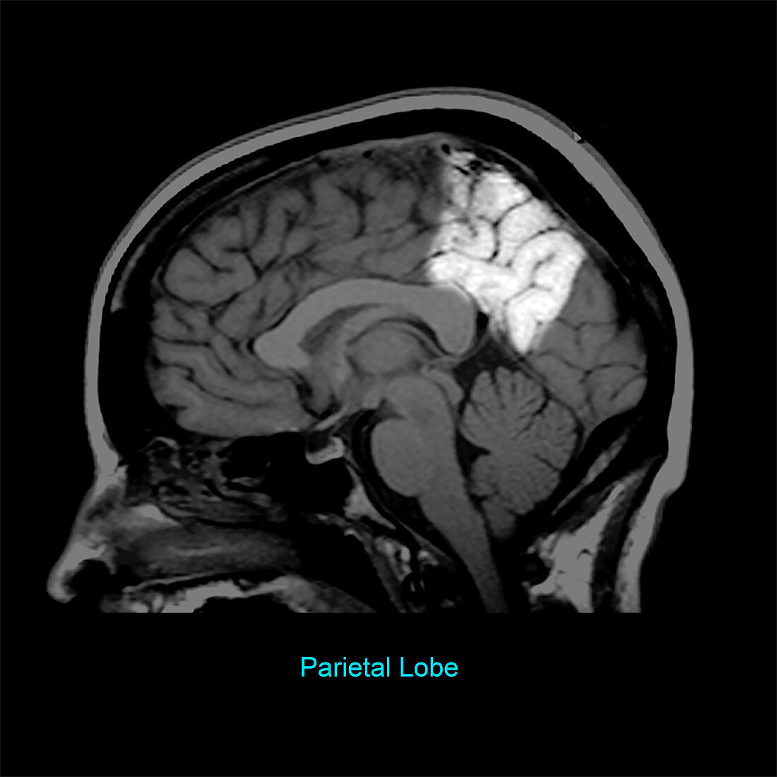 Parietal Lobe, Sagittal MRI