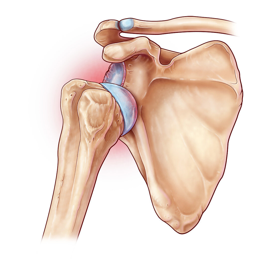 Dislocated Shoulder, Illustration
