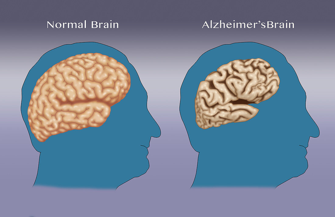 Alzheimer's and Normal Brains, Comparison