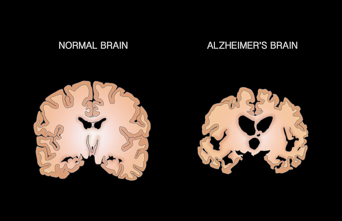 Alzheimer's and Normal Brains, Comparison