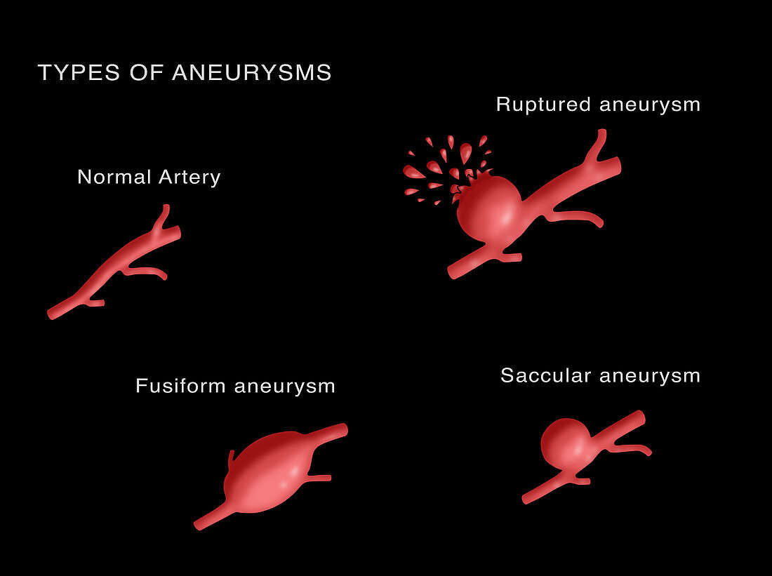 Types of Aneurysms
