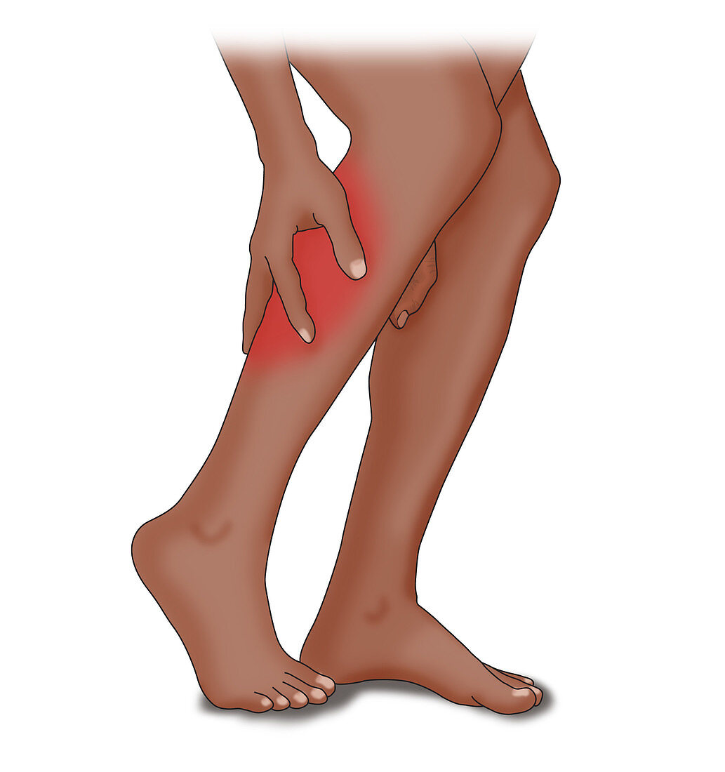 Leg Cramp Common Causes, Illustration
