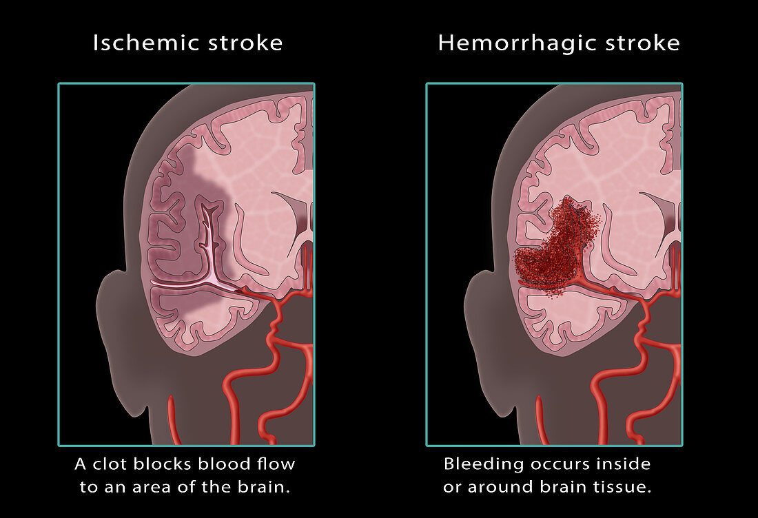 Ischemic & Haemorrhagic Stroke, Illustration