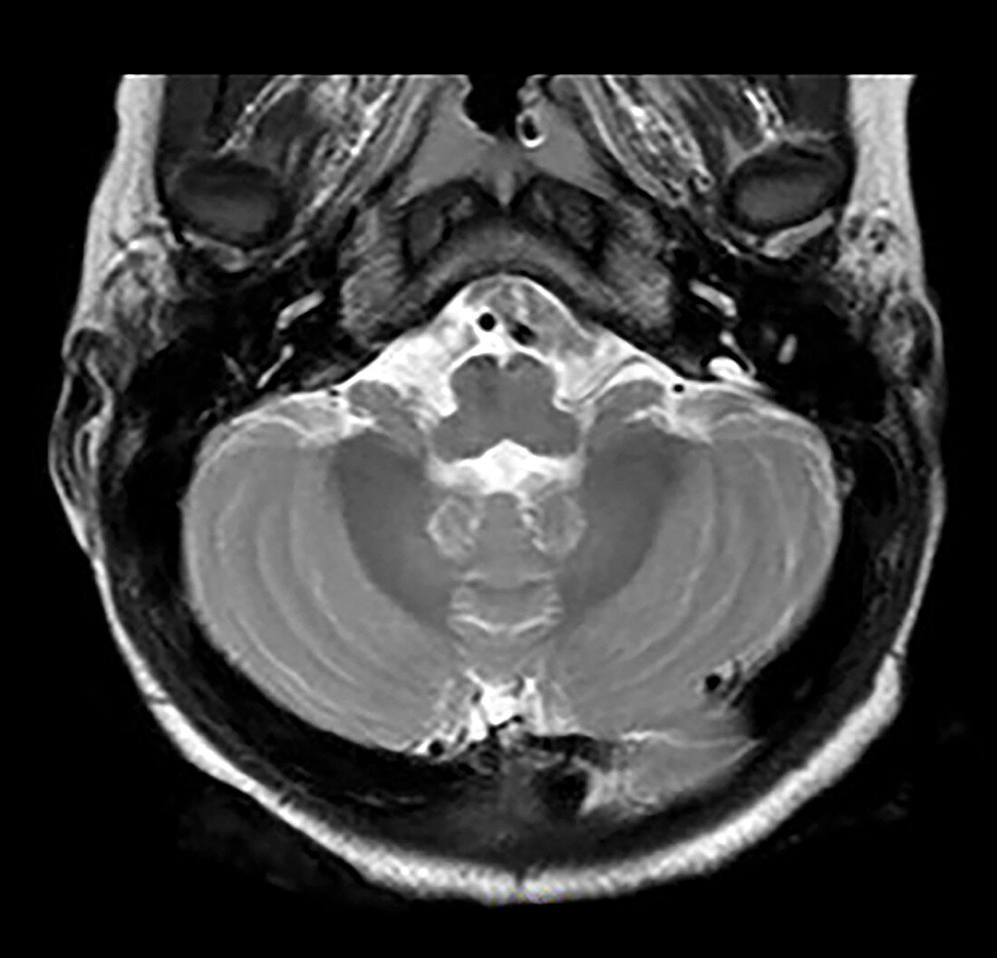 Large Vestibular Aqueduct, Hearing Loss, MRI