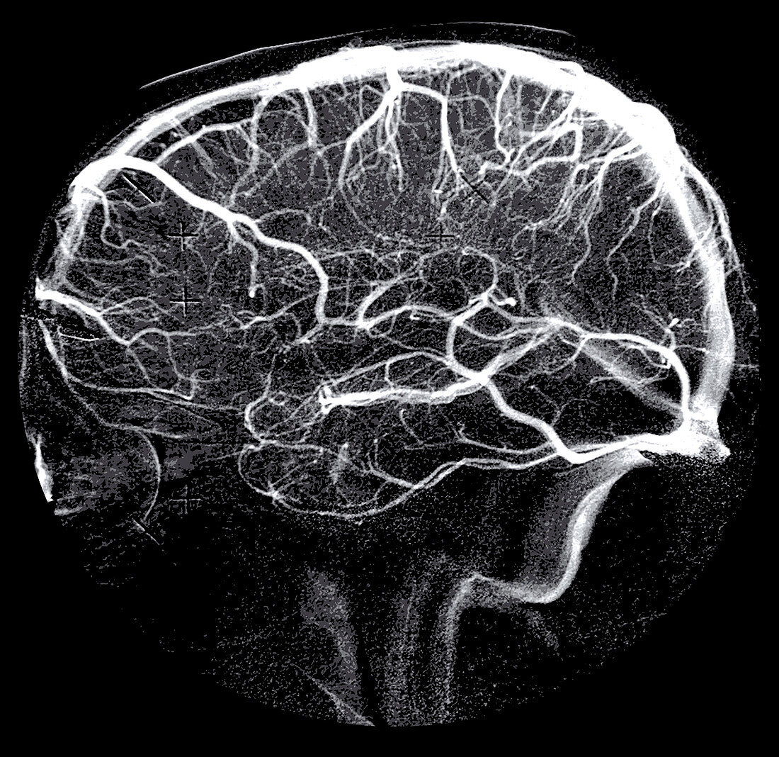 Venous Phase Cerebral Angiogram